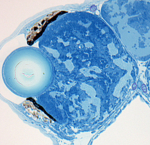 The photo shows a cross-section through a mutated fish larve eye. The cells are blue and the lens transparent. The cells behind the cells have a chaotic structure.