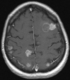 Magnetic resonance image of brain metastases.