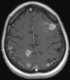 Hirnmetastasen im Magnetresonanztomografie-Bild