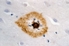 Mikroskopische Aufnahme einer Nervenzelle aus dem Gehirn eines Alzheimer-Patienten. Die Beta-Amyloid-Ablagerungen, die die Krankheit auslösen, sind braun angefärbt und ringförmig angeordnet.