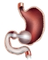 Trans-Duodenal_Barrier_Position.jpg