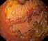 Colitis Ulcerosa