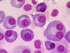Multiples Myelom