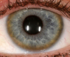 Kupferablagerungen im Auge