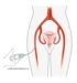 CeloNova_Verfahren_Uterus_Embolisation