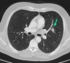 Lungenkrebs CT